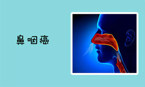 为什么听觉无缘无故的减退？可能是鼻咽癌的原因